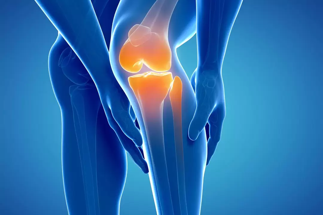 Artrosi dell'articolazione del ginocchio (gonartrosi, artrosi deformante)