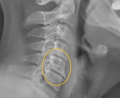 Osteocondrosi della colonna cervicale su un raggio X