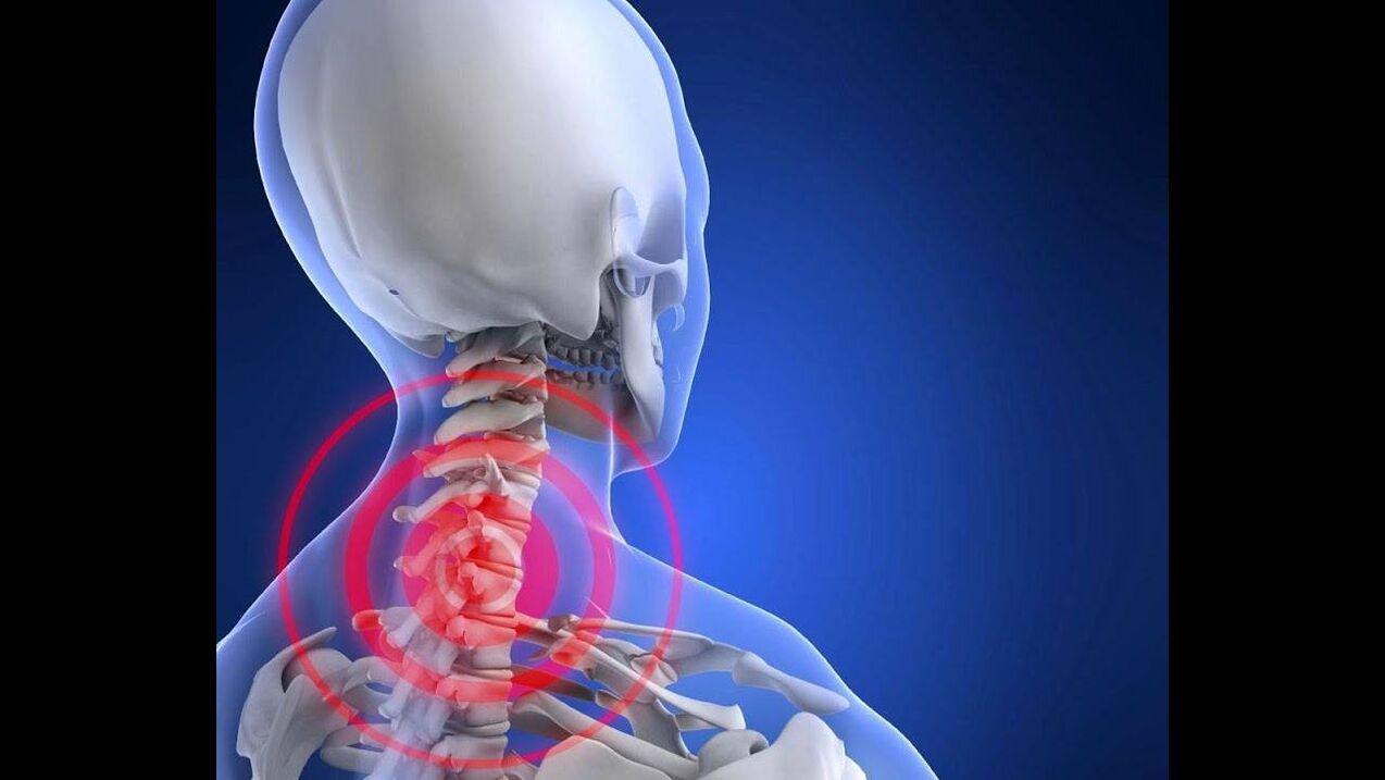 Osteocondrosi del rachide cervicale
